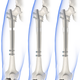 Leg lengthening procedure.